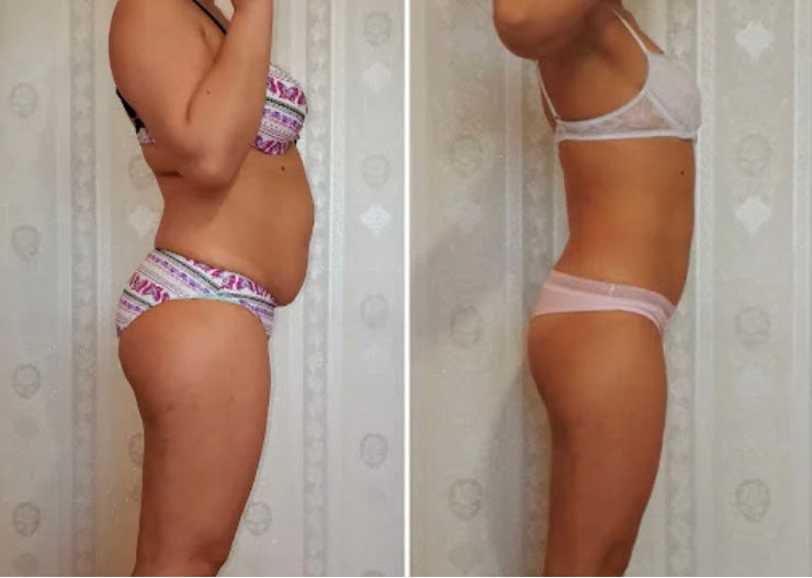 vor und nach der Gewichtsabnahme